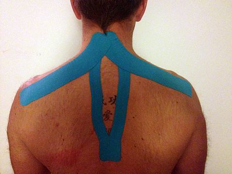 Beispielhafte Anwendung des Kinesiotapes am oberen Rücken bei Nackenverspannung. Beispielhafte Anwendung des Kinesiotapes am oberen Rücken bei Nackenverspannung.